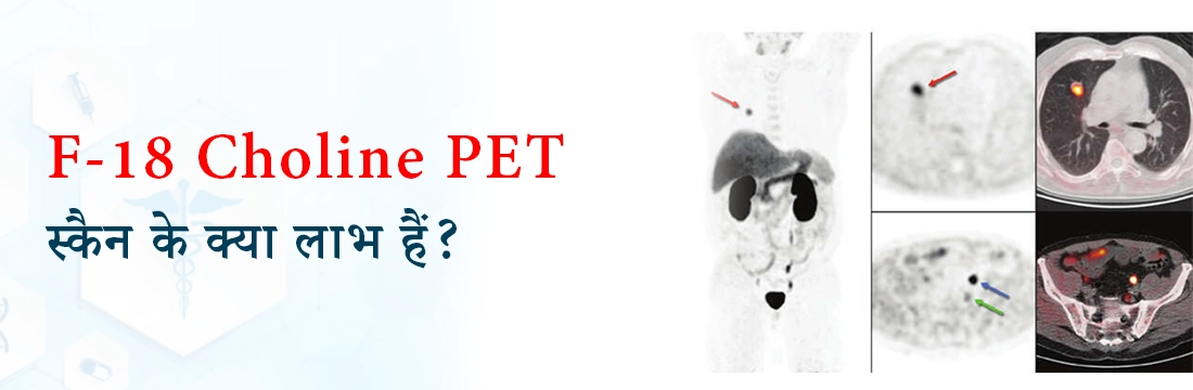 F-18 Choline PET स्कैन के क्या लाभ हैं?